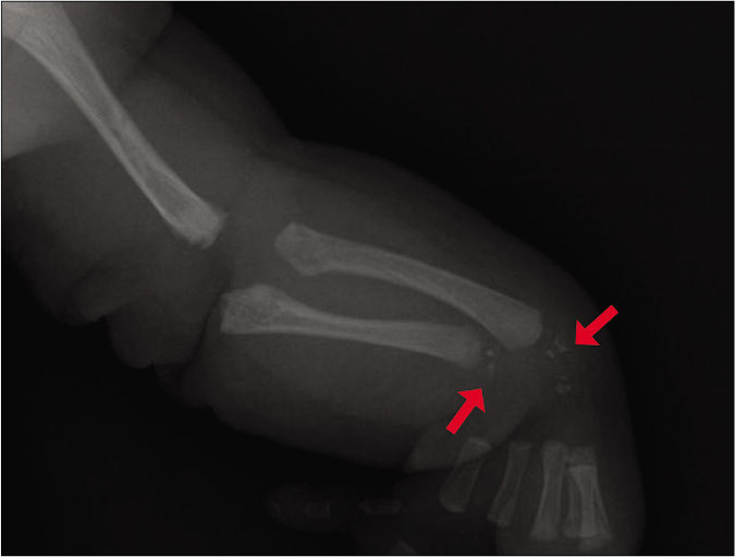 In the radius and the ulna, multiple prominent punctate stippled calcifications were observed (red arrows)