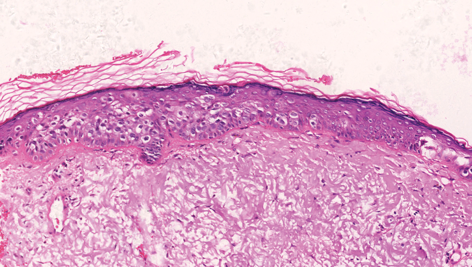 An Asymptomatic Erythematous Plaque On The Cheek Indian Journal Of Dermatology Venereology 2039