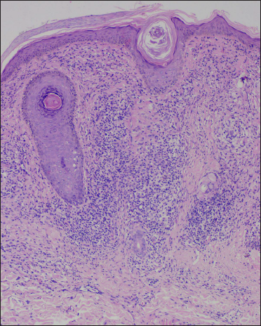 Clinicodermoscopic and immunopathological profile of non-infectious non ...