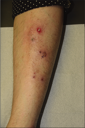 Clinicopathological features and prognosis of pyoderma gangrenosum in ...