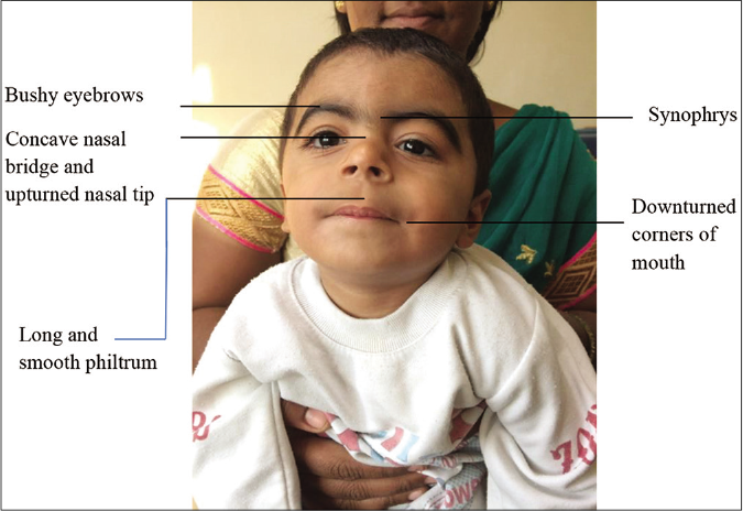 Cardinal features of Cornelia de Lange syndrome (as shown)