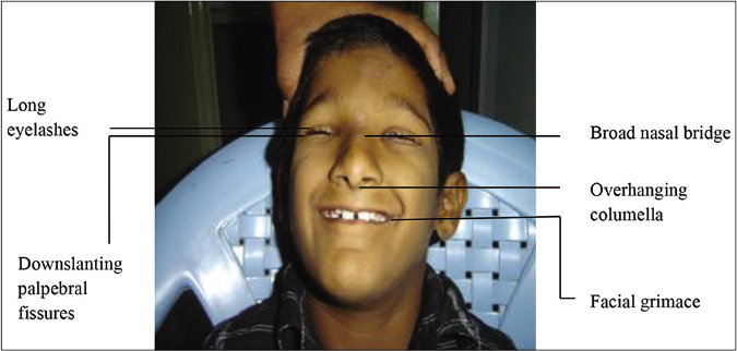 Facial features of Rubinstein-Taybi syndrome