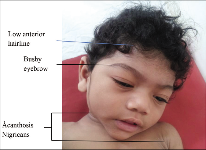 Facial features of Berardinelli-Seip syndrome include mild coarsening, acromegaloid appearance, low anterior hairline, bushy eyebrows, large ears