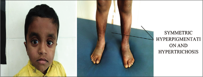 Cutaneous features of H syndrome