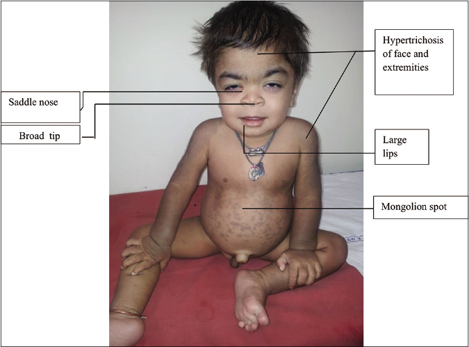 Approach to inherited hypertrichosis A brief review Indian