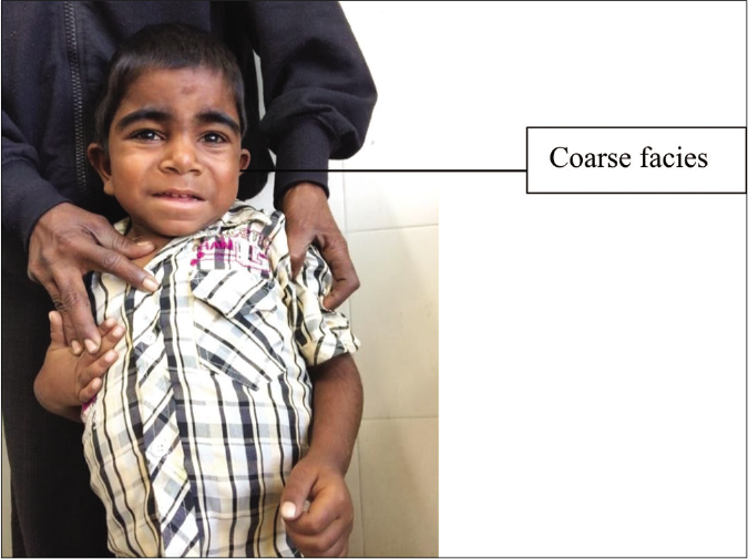 Cardinal features of mucopolysaccharidosis II include male preponderance, hypertrichosis, coarse facies, hepatosplenomegaly, sclerodermoid infiltration of extremities, multiple ivory white papules in subscapular area