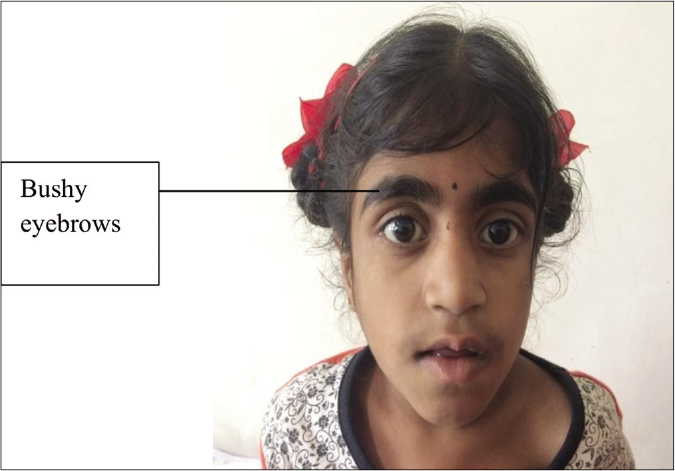 Approach to inherited hypertrichosis: A brief review - Indian