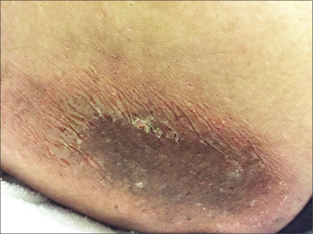 Brownish hyperkeratotic scaly plaque, surrounded by an erythematous to purpuric halo on the left thigh