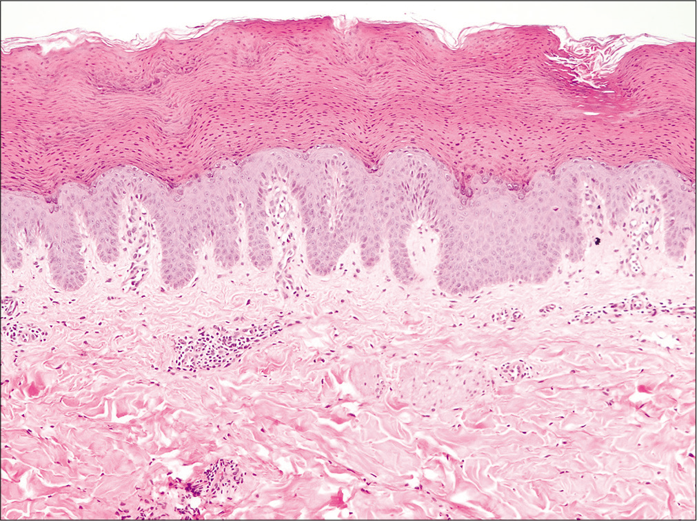 Thick stratum corneum with retention of nuclei and basophilic keratohyalin granules (H and E, ×100)