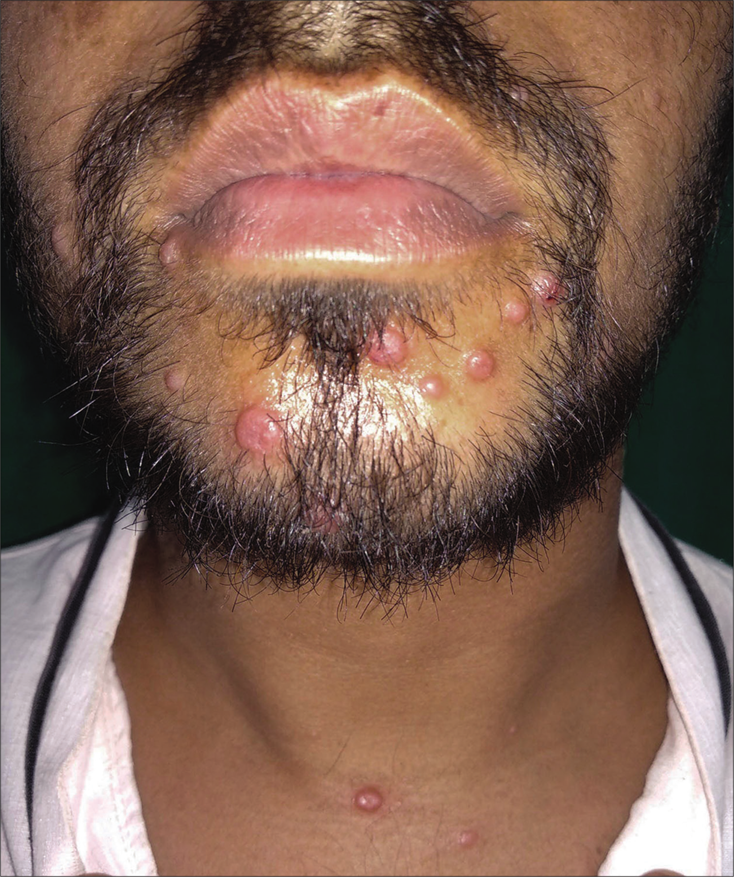 Multiple erythematous dome-shaped nodules on the face and neck