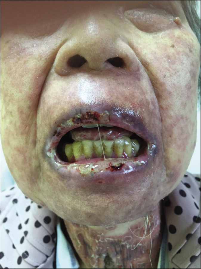 Multiple erosions and hemorrhagic crusts over her lips