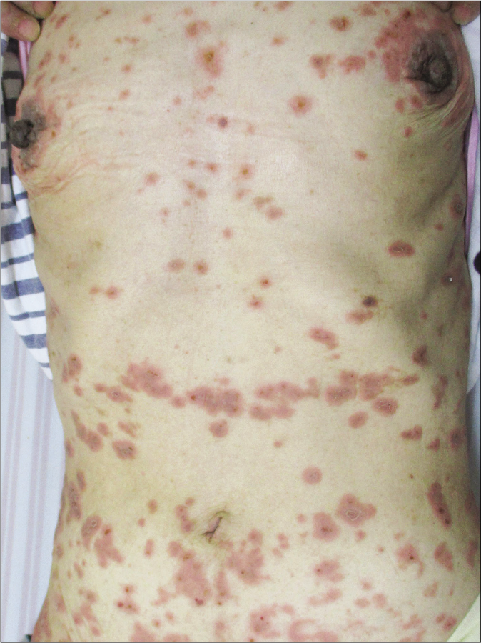 Diffuse erythematous plaques, target lesions and blisters on the trunk