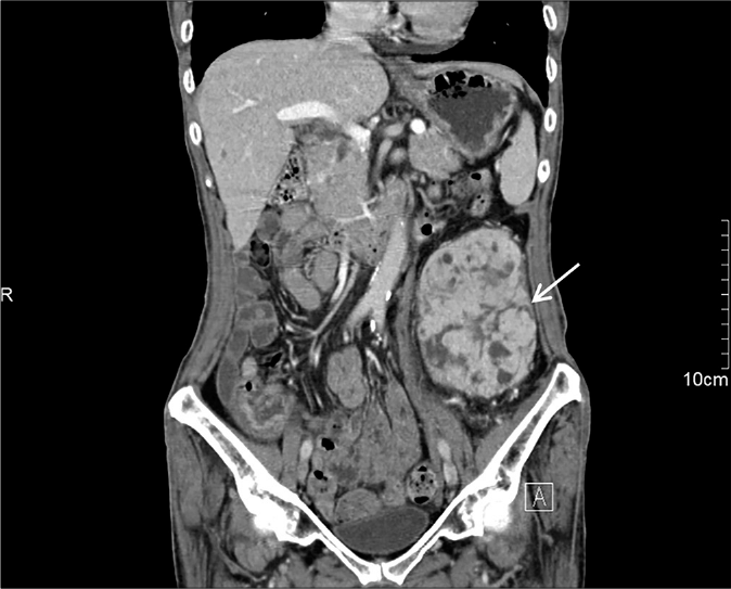 Abdominal contrast-enhanced computed tomography revealed a 11.5 × 9 × 6.5 cm sized soft tissue mass with necrosis (white arrowhead)