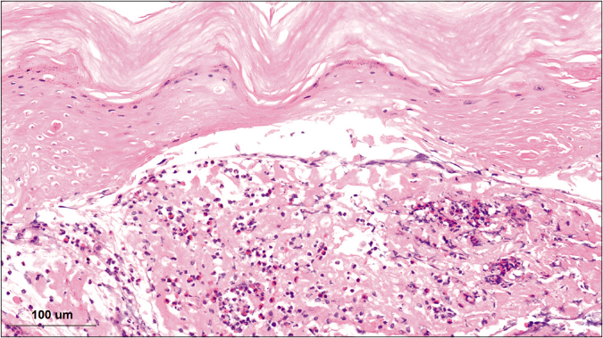 Skin biopsy shows acantholysis, intraepidermalblister and infiltrate of lymphocytes and eosinophils (hematoxylin-eosin stain x500)