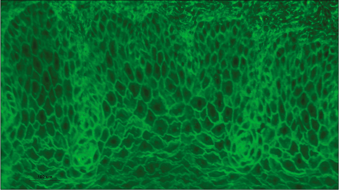 Direct immunofluorescence revealed IgG deposition in the intercellular spaces in a reticular pattern (x500)