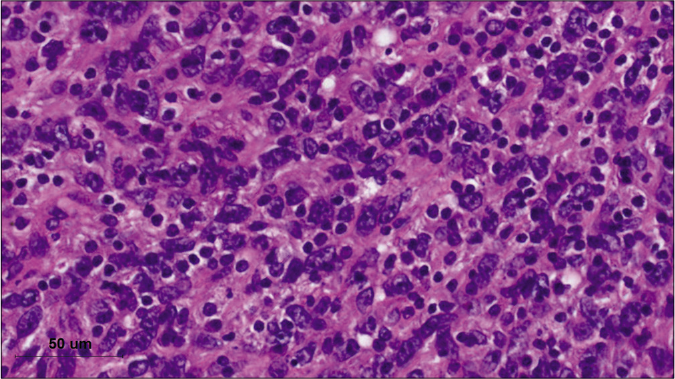 Histologic findings of the mass reveal spindle-to-ovoid tumor cells forming in a whirlpool or storiform patterns, intermingled with dense lymphocytes (hematoxylin-eosin stain, x1000)