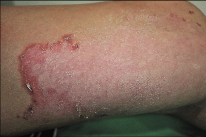 Final pruritic erythema prior to implantation of a polyethylene