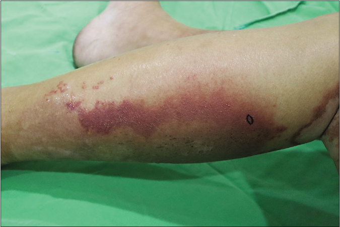 Plaques with pustules on the left calf. Biopsy site is marked.
