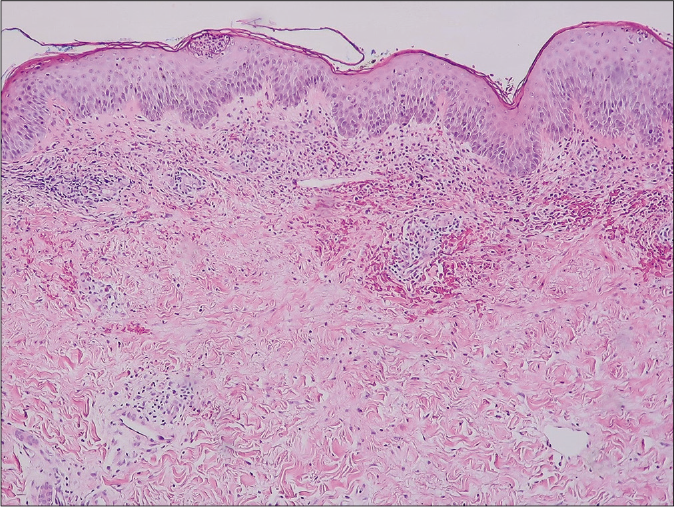 Subcorneal pustule, perivascular and interstitial infiltrate in the upper dermis with erythrocyte extravasation and mild papillary dermal edema. (hematoxylin and eosin, ×100)