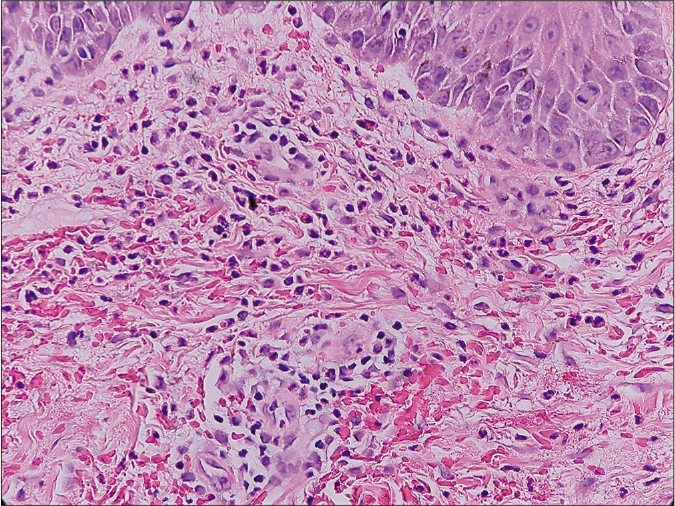 The dermal infiltrate composed predominantly of neutrophils. (hematoxylin and eosin, ×400)