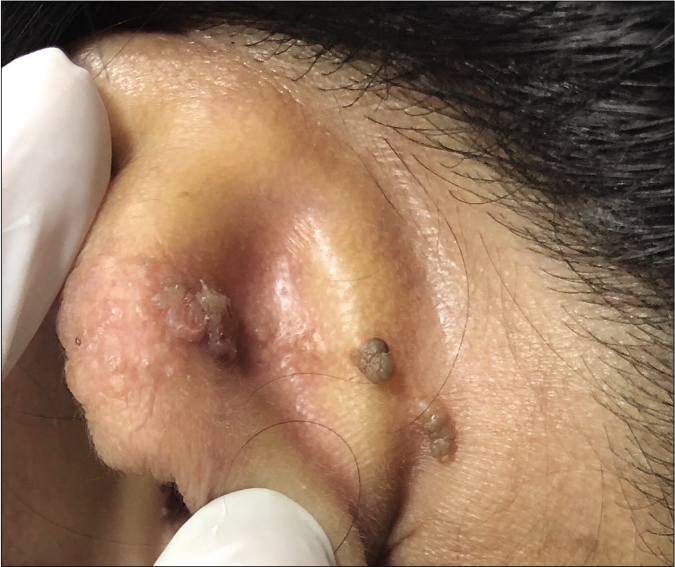 Skin colored to hyperpigmented verrucous surfaced papules in linear pattern