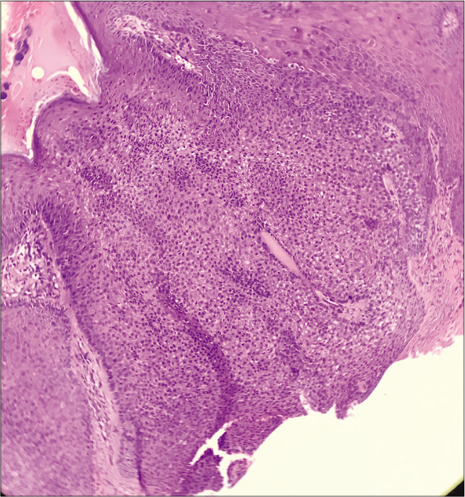 Circumscribed lobular neoplasm connected to overlying epidermis (H and E ×40)