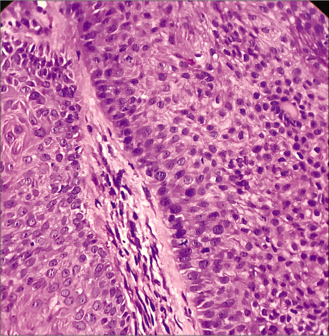 Basaloid cells arranged in a palisade and resting on thickened basement membrane (H and E ×400)