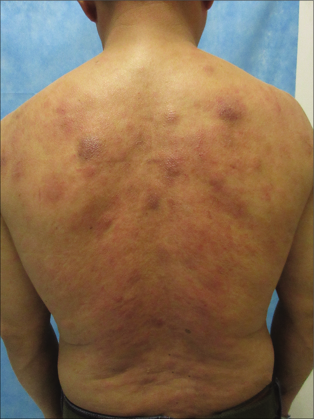 Multiple erythematous plaques and nodules on the back