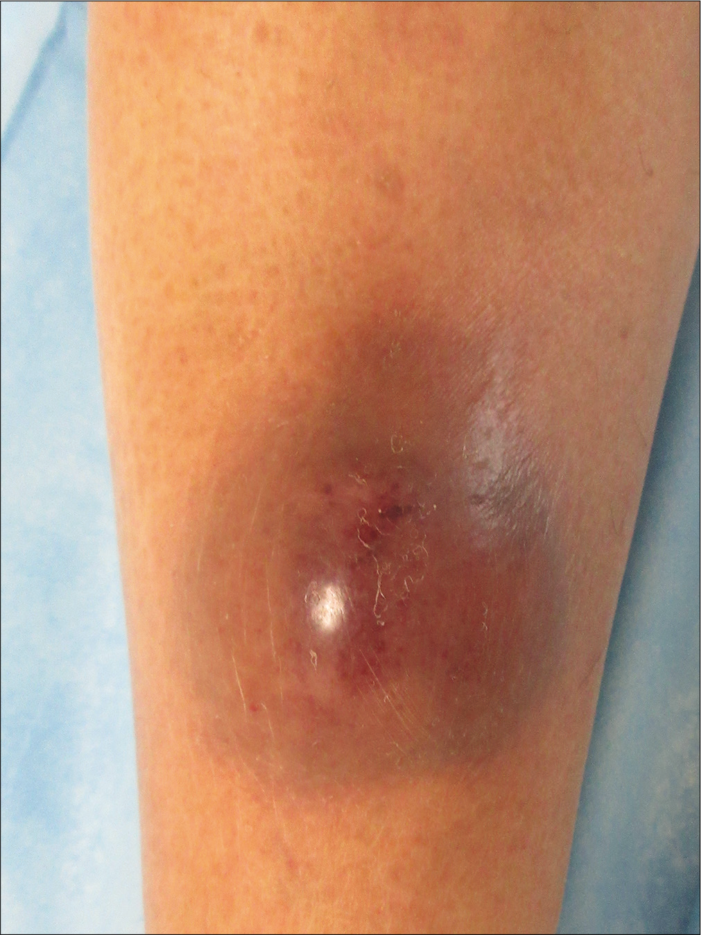 An erythematous nodule on the extensor of the right leg