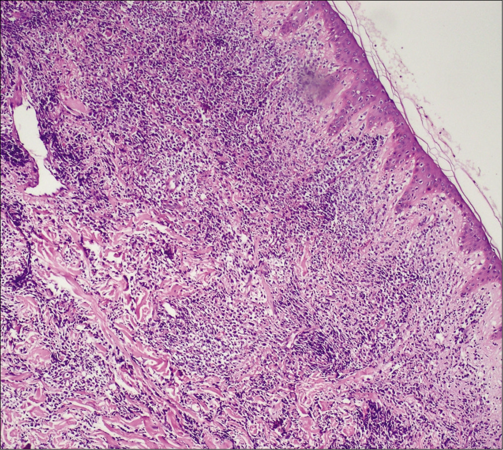 A diffuse and nodular infiltrate of medium-sized monomorphic tumor cells throughout the dermis and subcutaneous tissues with a relatively normal epidermis (Hematoxylin and eosin, ×100)