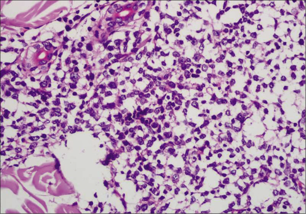 Infiltrate of medium-sized monomorphic tumor cells (Hematoxylin and eosin, ×400)