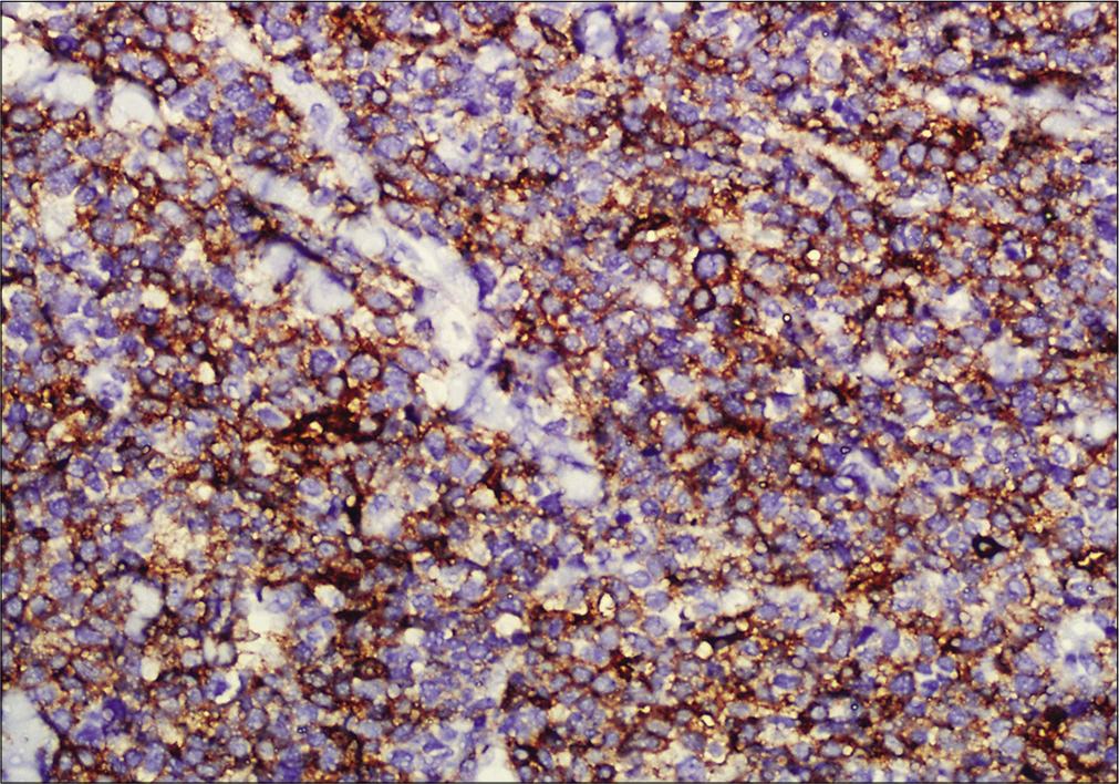 Immunohistochemistry showing tumor cells positive for CD4 (×200)