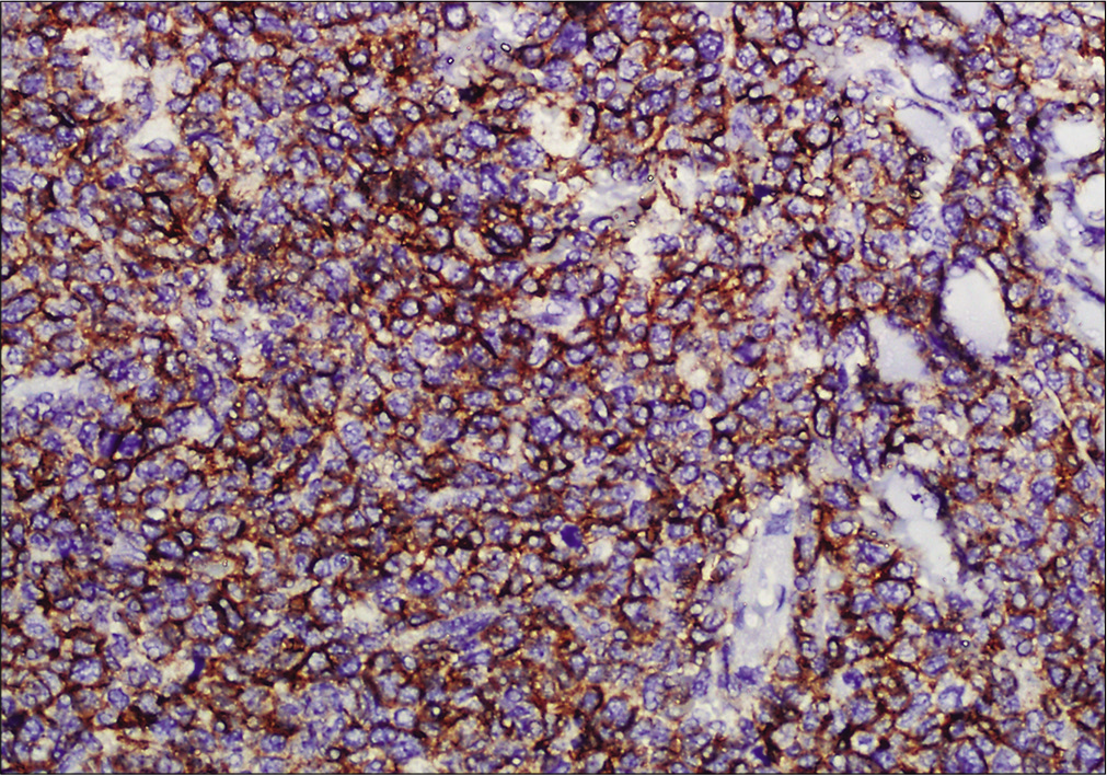 Immunohistochemistry showing tumor cells positive for CD56 (×200)