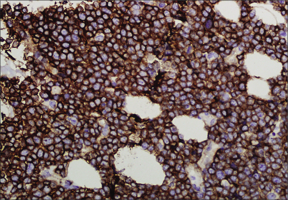 Immunohistochemistry showing tumor cells positive for Ki-67 (×400)