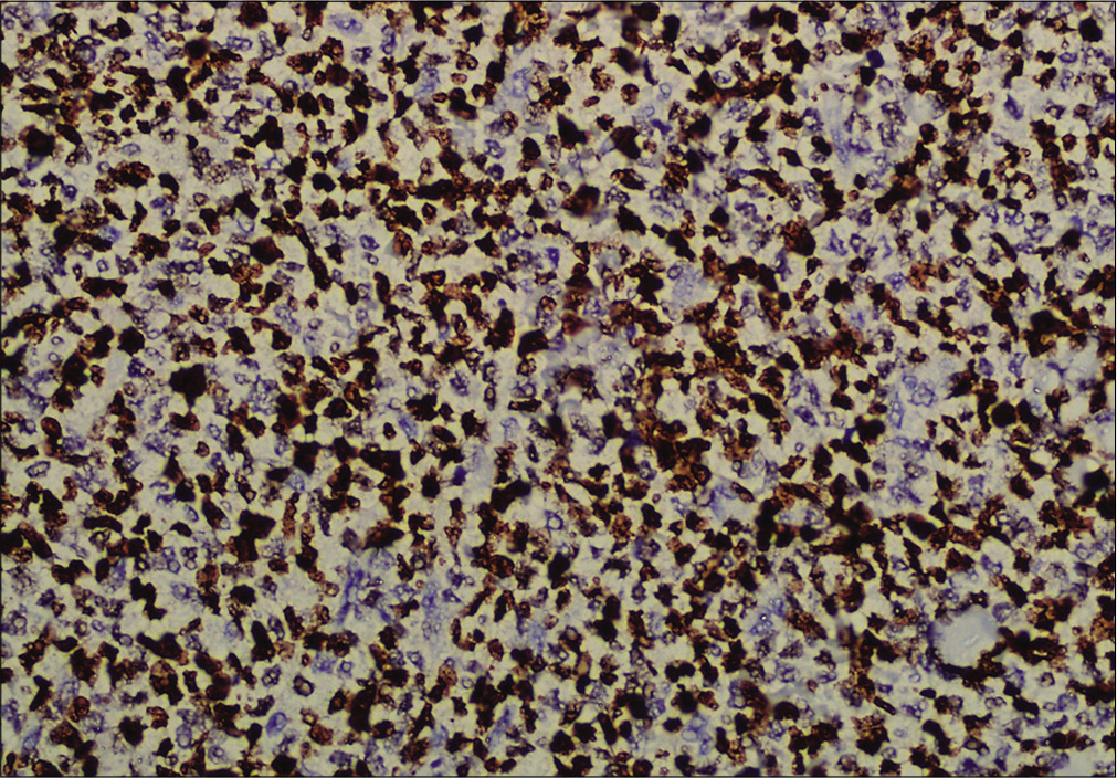 Immunohistochemistry showing tumor cells positive for CD123 (×200)