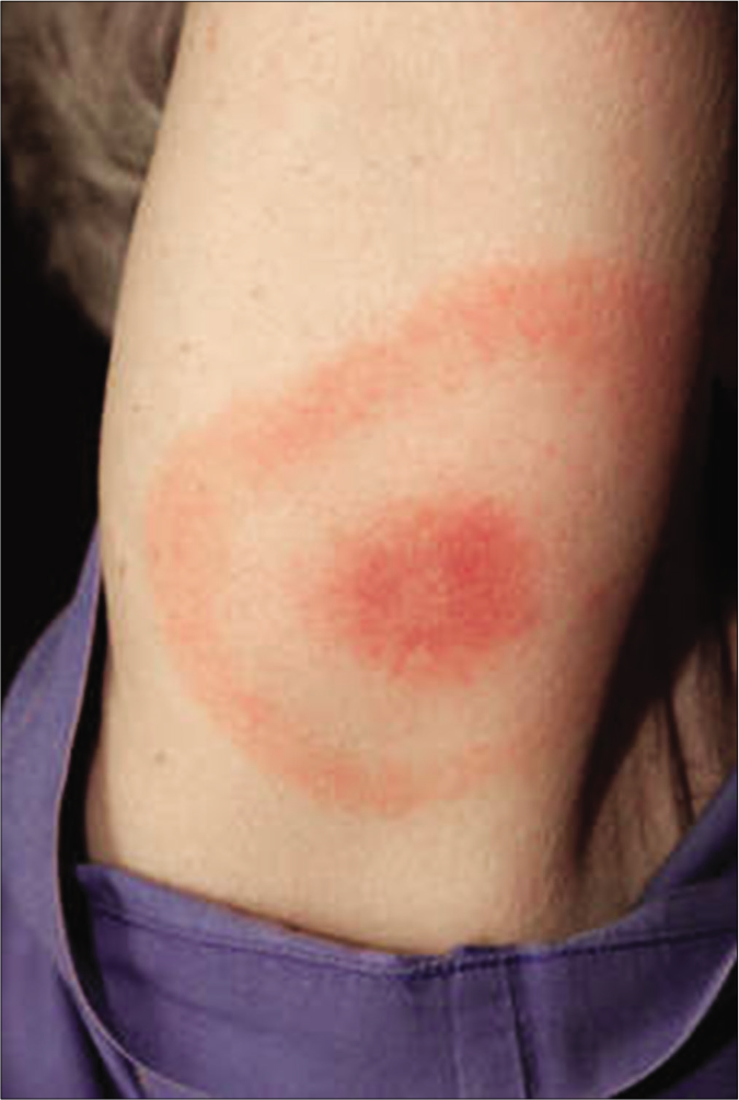 Erythema migrans (Lyme’s disease)