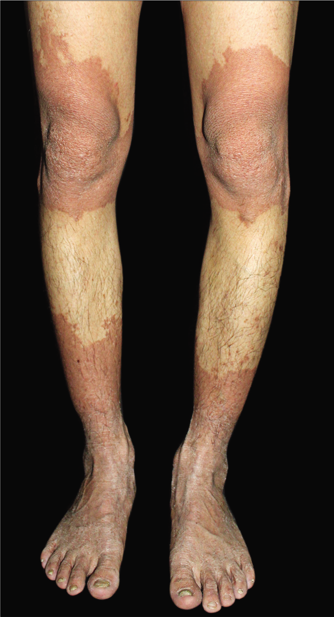 The proband with symmetrically distributed and sharply demarcated erythematous hyperkeratotic plaques on knees, calves, ankles, feet and elbows, sparing the trunk