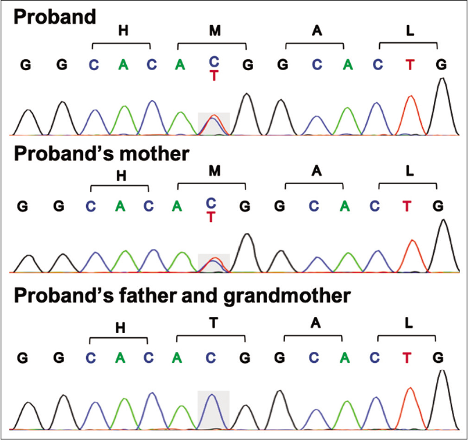 Sanger sequencing of ELOVL4 revealed heterozygous missense mutation c.698C>T (p.T233M) in the proband and his mother which was not found in his father and grandmother