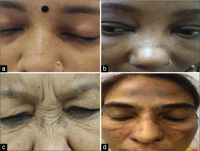 (a) Pigmented transverse nasal band, (b) Transverse nasal view (close-up view), (c) Aging wrinkles (courtesy Dr. Saloni Katoch), (d) Melasma involving the dorsum of nose (courtesy Dr. Surabhi Sinha)