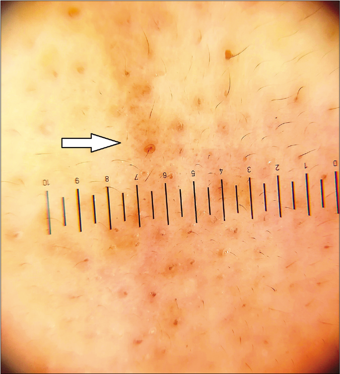 Pigmented transverse nasal band showing brownish dot on dermoscopy indicative of microcomedone, Heine Delta 20 T (×10)