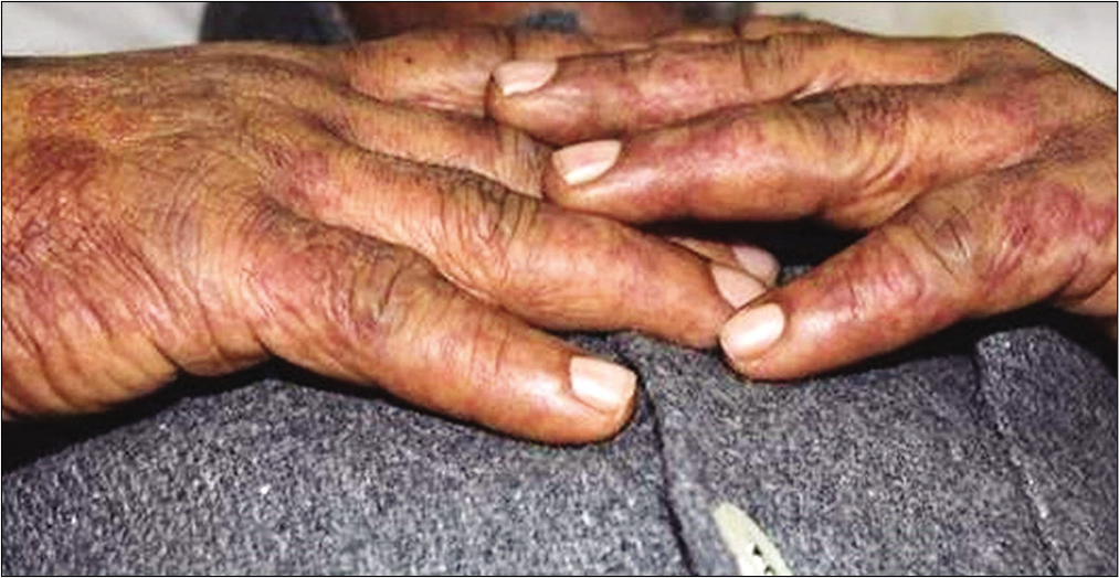 Annular purpuric lesions on dorsum of hands