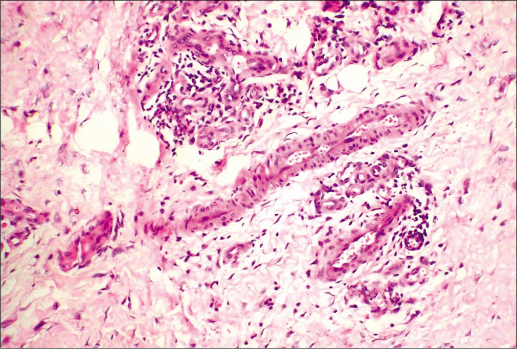 Features of vasculitis: fibrinoid necrosis and leukocytoclasis (H and E,×40)