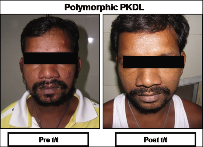 Representative clinical features of a patient with polymorphic post kala-azar dermal leishmaniasis at disease presentation (Pre t/t) and following completion of treatment with liposomal amphotericin b (Post t/t)