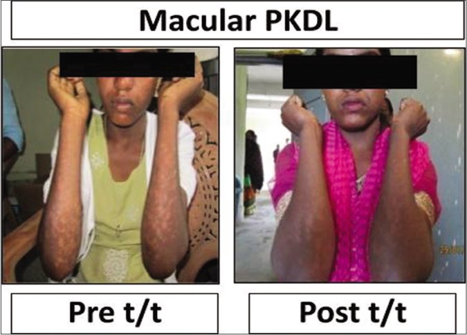 Representative clinical features of a patient with macular post kala-azar dermal leishmaniasis at disease presentation (Pre t/t) and following completion of treatment with liposomal amphotericin b (Post t/t)