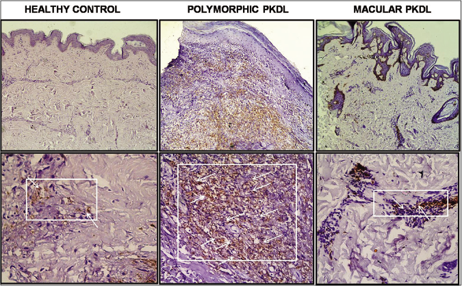 Status of CD68+ cells in dermal biopsies of patients with post kala-azar dermal leishmaniasis:representative immunohistochemical profiles of a healthy control and a patient with polymorphic or macular post kala-azar dermal leishmaniasis (using horseradish peroxidase and 3,3'-diaminobenzidine as the chromogenic substrate,×100 and ×400 magnification [as indicated by white arrows])