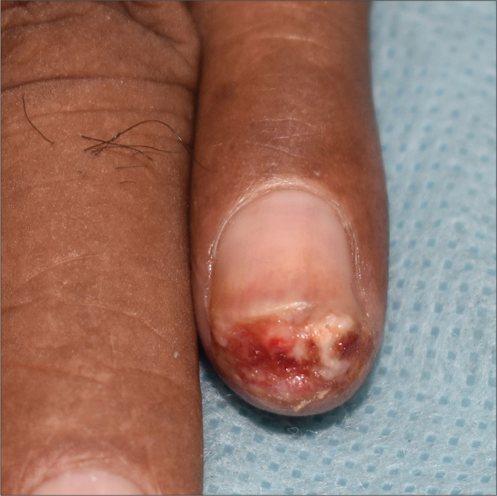 skin ulcer on finger