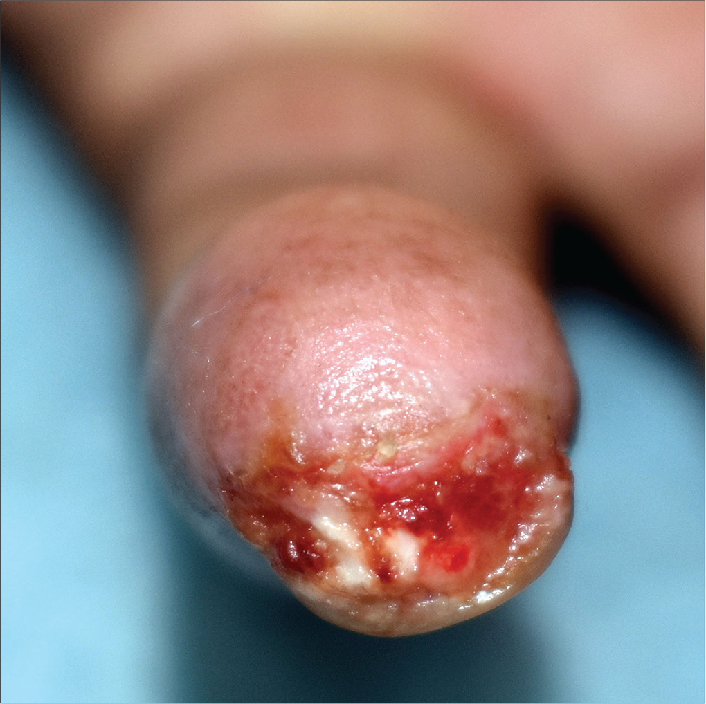 Round-to-oval ulcer with erythematous fleshy eroded granulation tissue present on the hyponychium extending to the fingertip (ventral view)