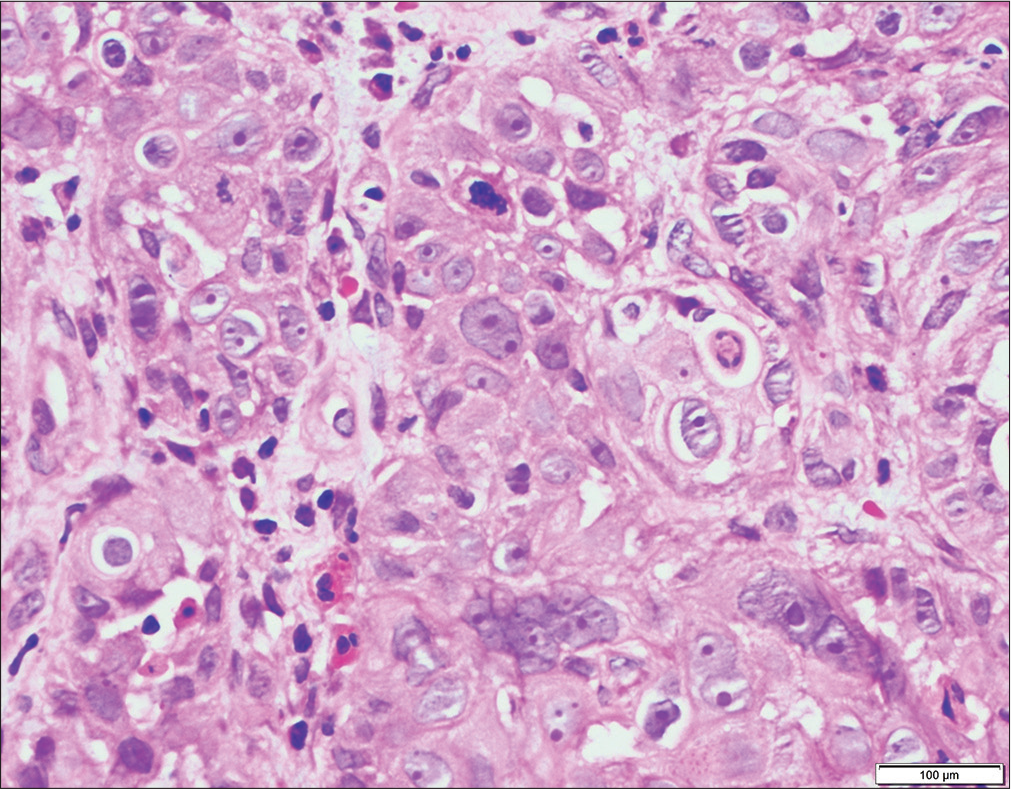 Higher magnification shows that the cells are polygonal with pleomorphic vesicular nuclei, prominent eosinophilic nucleoli and a moderate amount of eosinophilic cytoplasm. Dyskeratotic keratinocytes and mitotic figures are also seen (H and E, ×400).