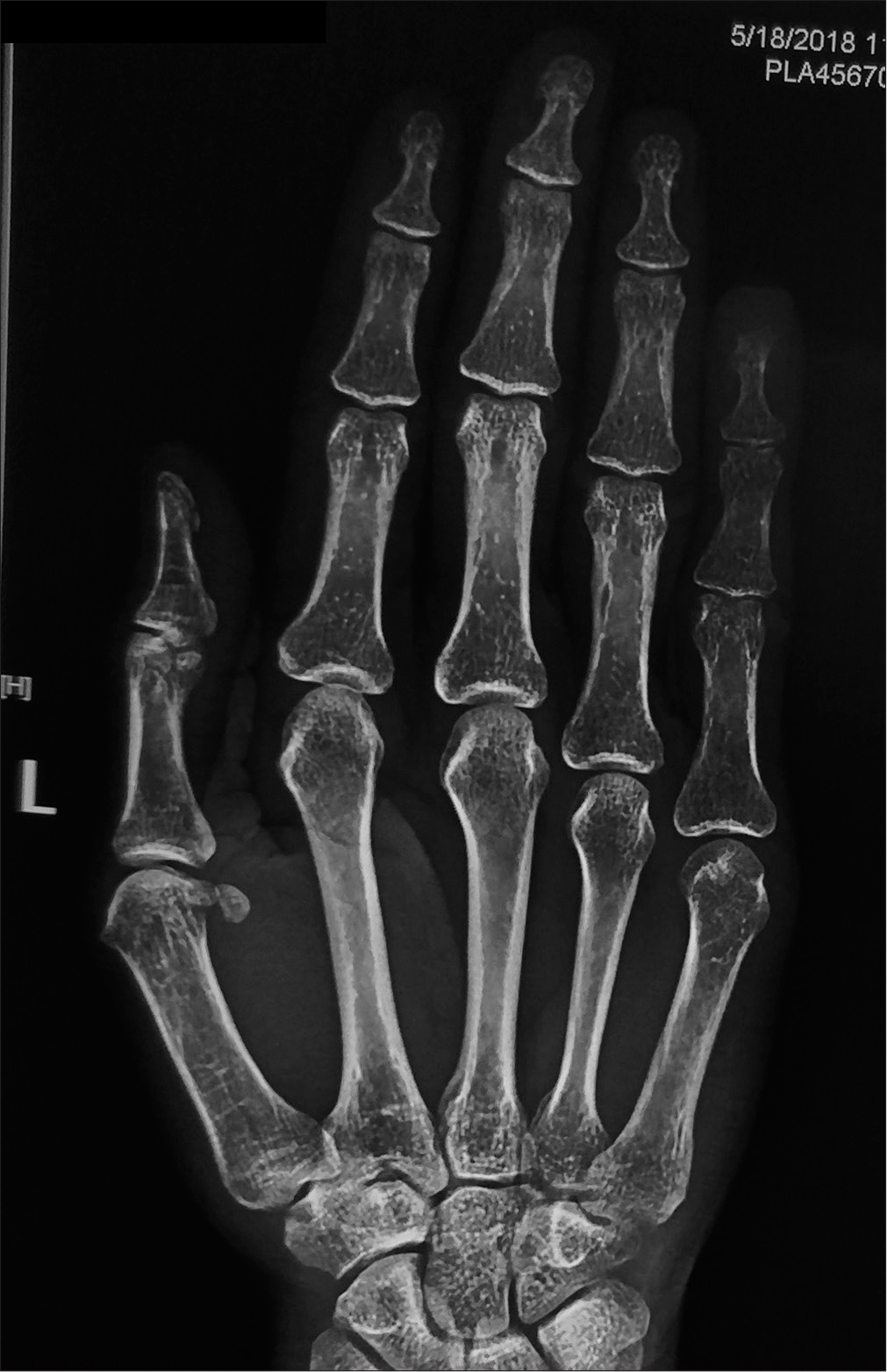 X-ray of the left hand showing mild erosion of left 5th distal phalanx