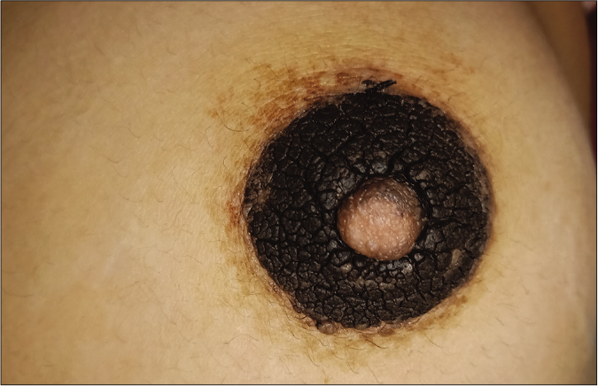 Hyperpigmented verrucous plaque on areola and nipple